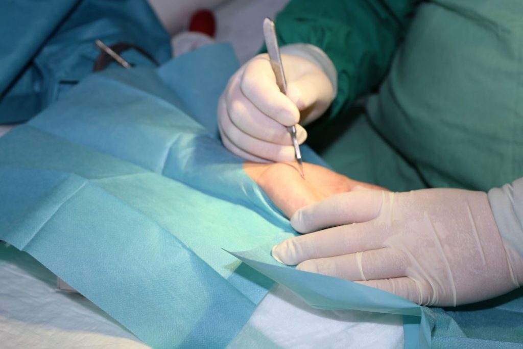 karpalni kanal kirurško zdravljenje